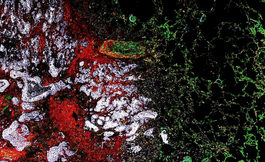 Microscopic image showing a pattern of green, red, white, and black areas respresenting the complex biological structures that make up a tumour microenvirionment